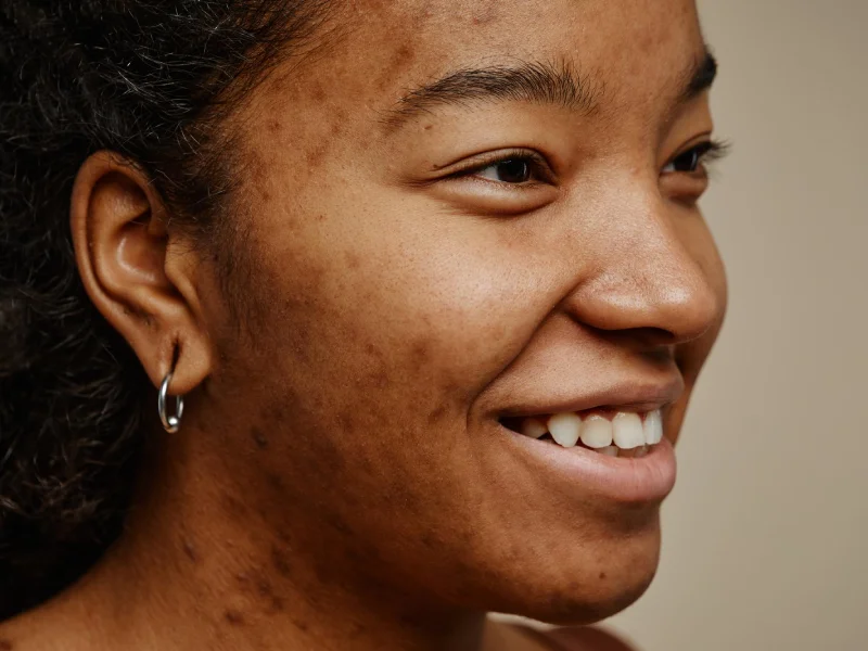 Light-skinned lady with hyperpigmentation