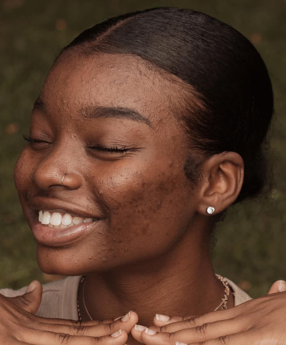 Photo: Getty images/hormonal acne 